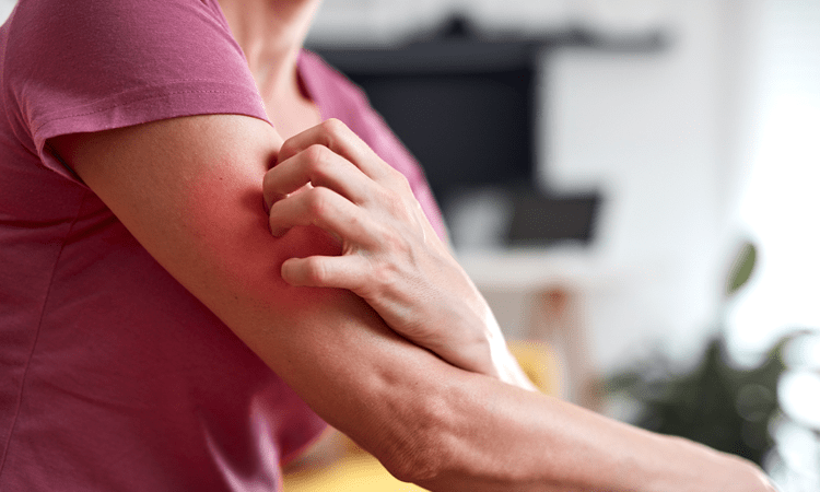 Pbc Rash PBC Itch Management | Tips for Managing Itching in PBC